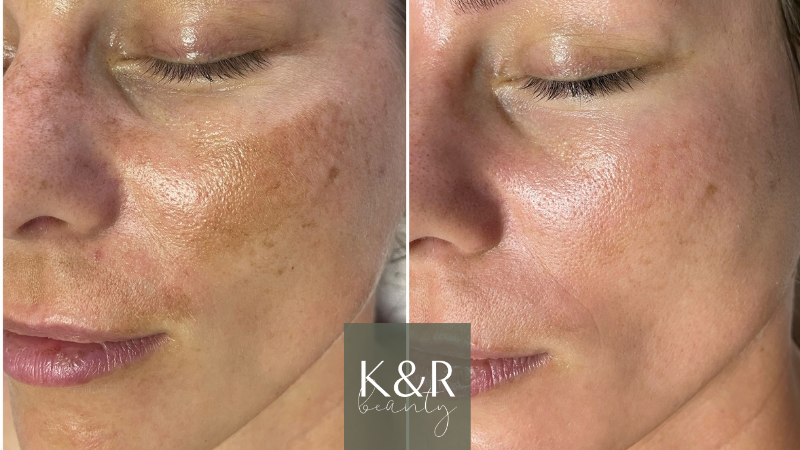GREEN PEEL® Fresh Up -kasvohoito 99 €